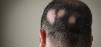 Alopecia Areata